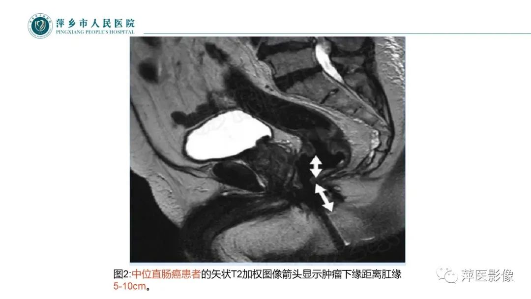 【PPT】直肠癌MR分期-28