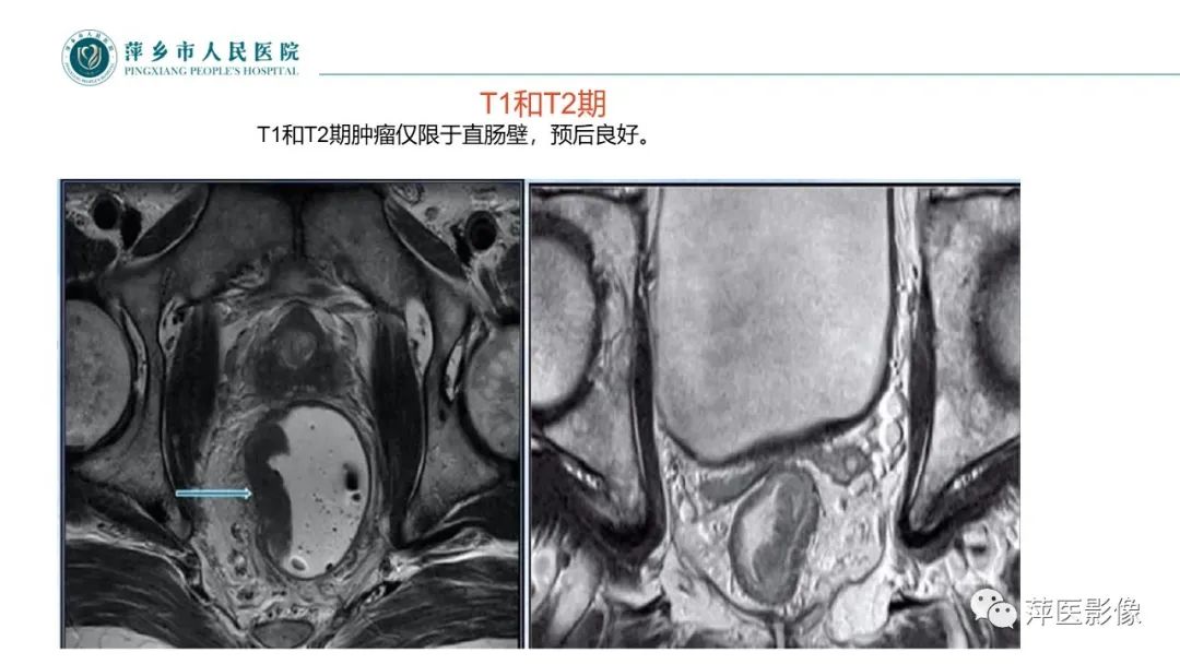 【PPT】直肠癌MR分期-32
