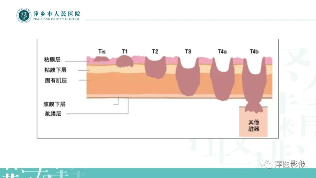 【PPT】直肠癌MR分期-11