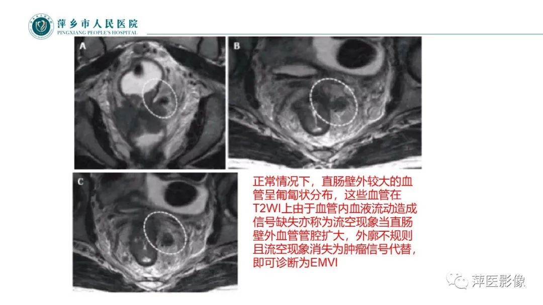 【PPT】直肠癌MR分期-20