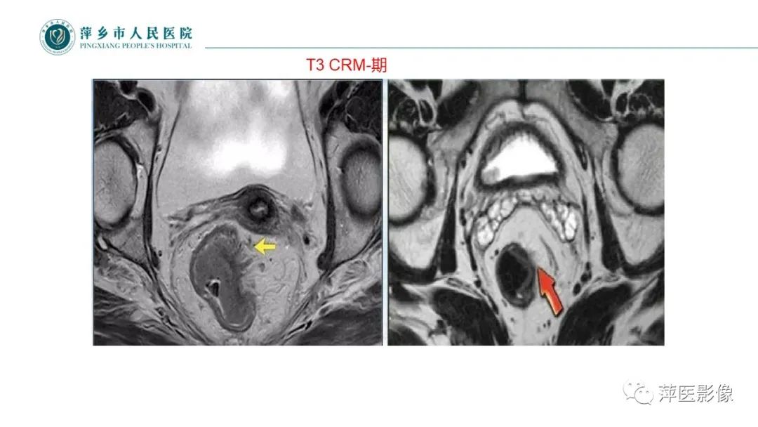 【PPT】直肠癌MR分期-34