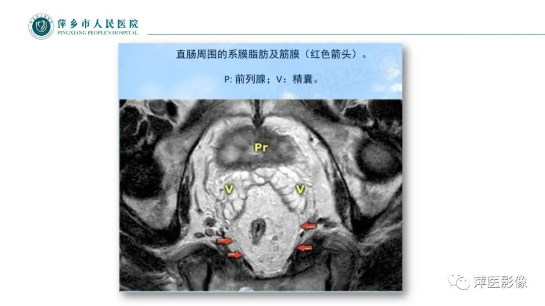 【PPT】直肠癌MR分期-17