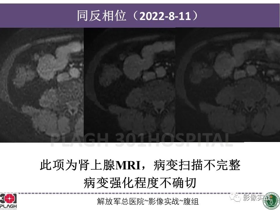 【病例】小肠间质瘤1例CT影像-7