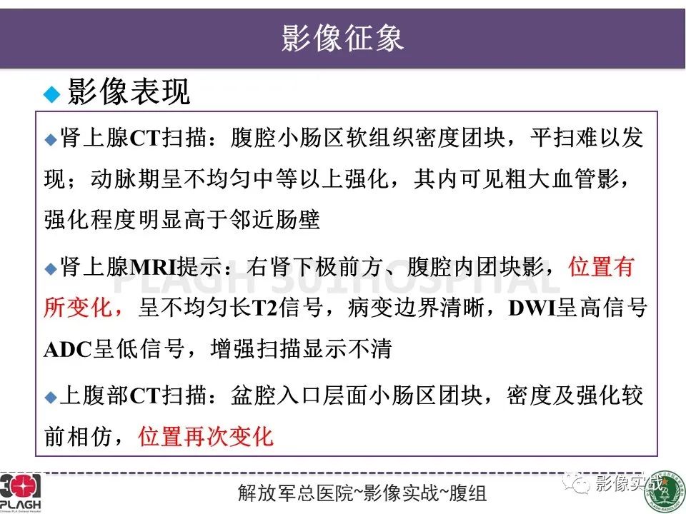 【病例】小肠间质瘤1例CT影像-11