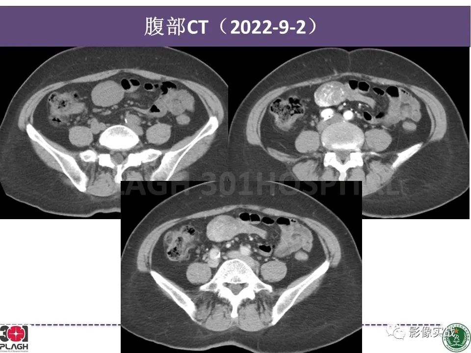 【病例】小肠间质瘤1例CT影像-8