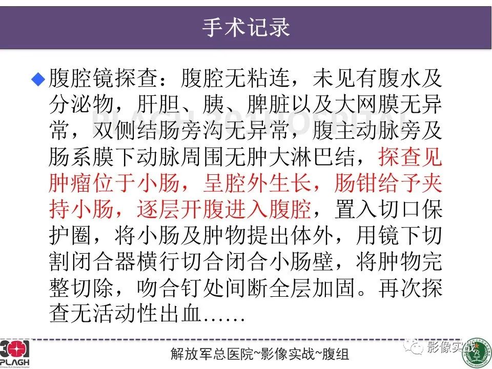 【病例】小肠间质瘤1例CT影像-17