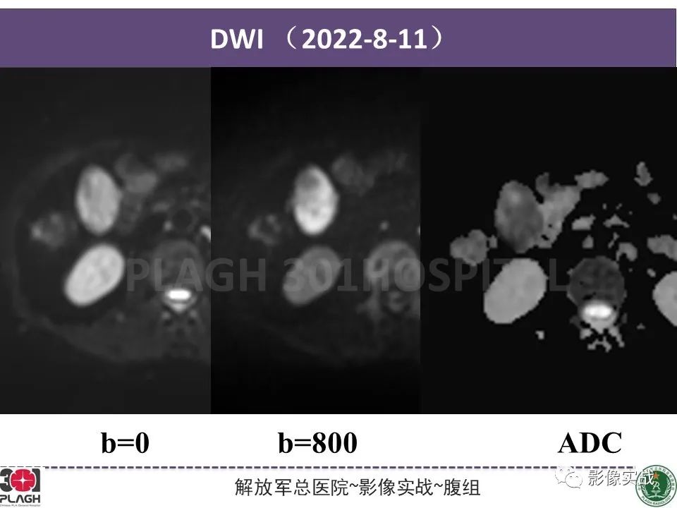 【病例】小肠间质瘤1例CT影像-6