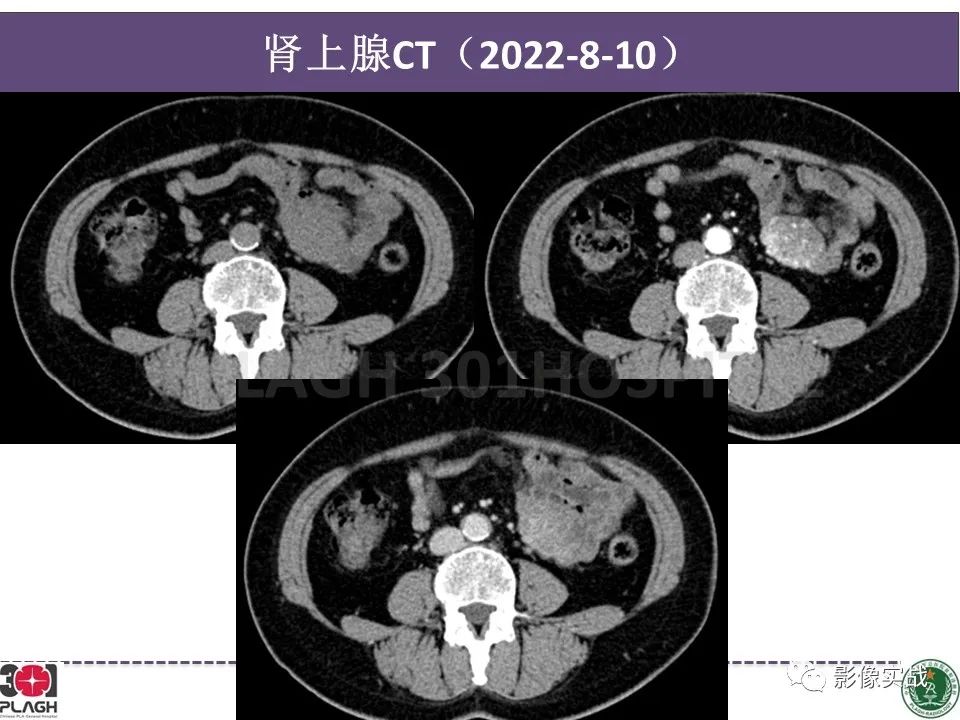 【病例】小肠间质瘤1例CT影像-4