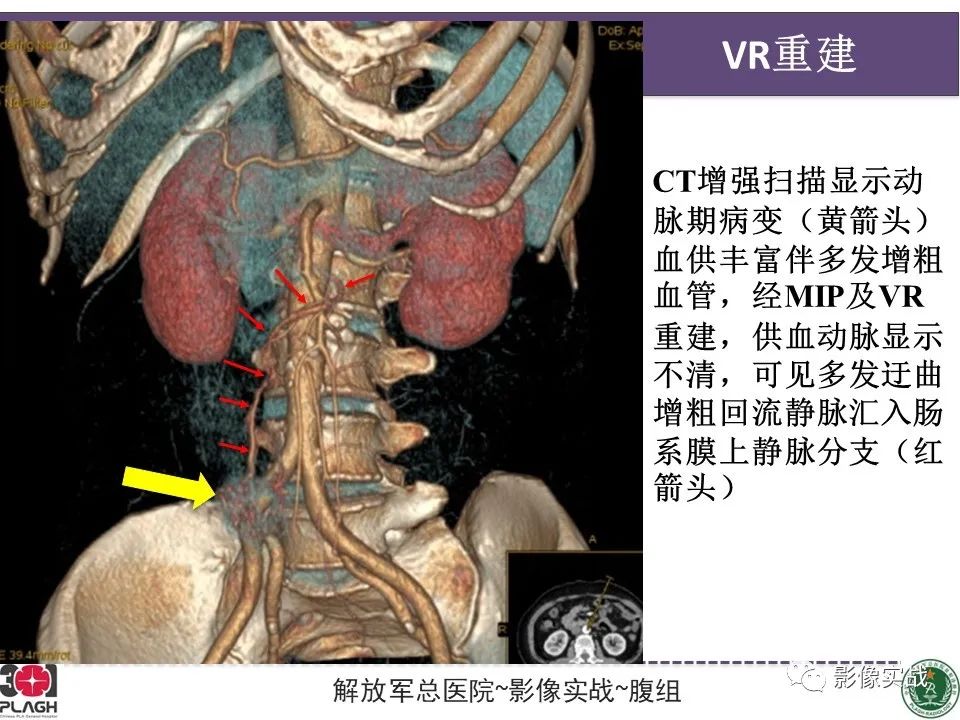 【病例】小肠间质瘤1例CT影像-9
