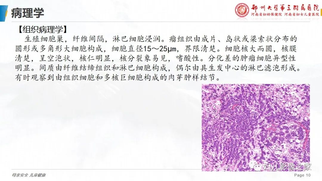 【病例】卵巢无性细胞瘤1例CT及MR影像-10