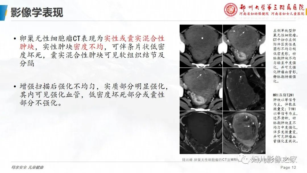 【病例】卵巢无性细胞瘤1例CT及MR影像-12