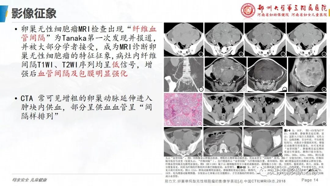 【病例】卵巢无性细胞瘤1例CT及MR影像-14