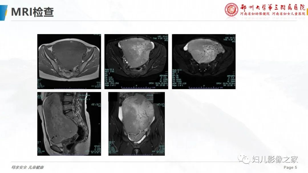 【病例】卵巢无性细胞瘤1例CT及MR影像-5