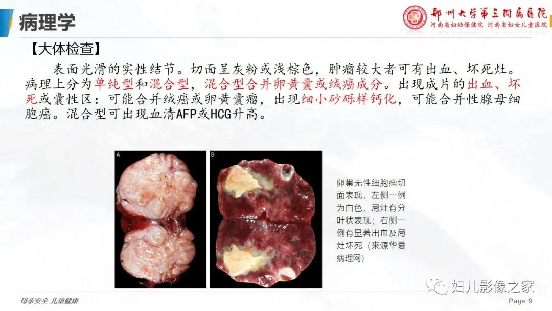 【病例】卵巢无性细胞瘤1例CT及MR影像-9
