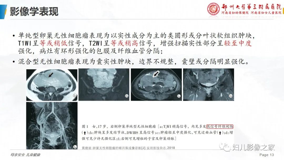 【病例】卵巢无性细胞瘤1例CT及MR影像-13