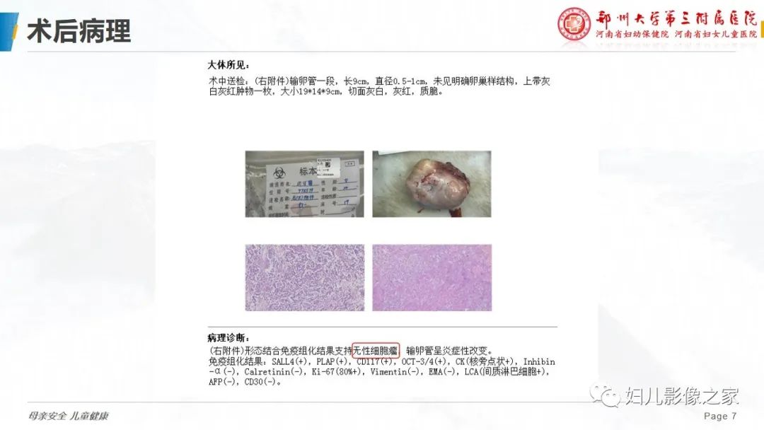 【病例】卵巢无性细胞瘤1例CT及MR影像-7