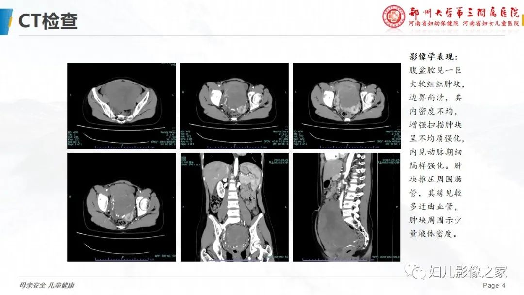 【病例】卵巢无性细胞瘤1例CT及MR影像-4