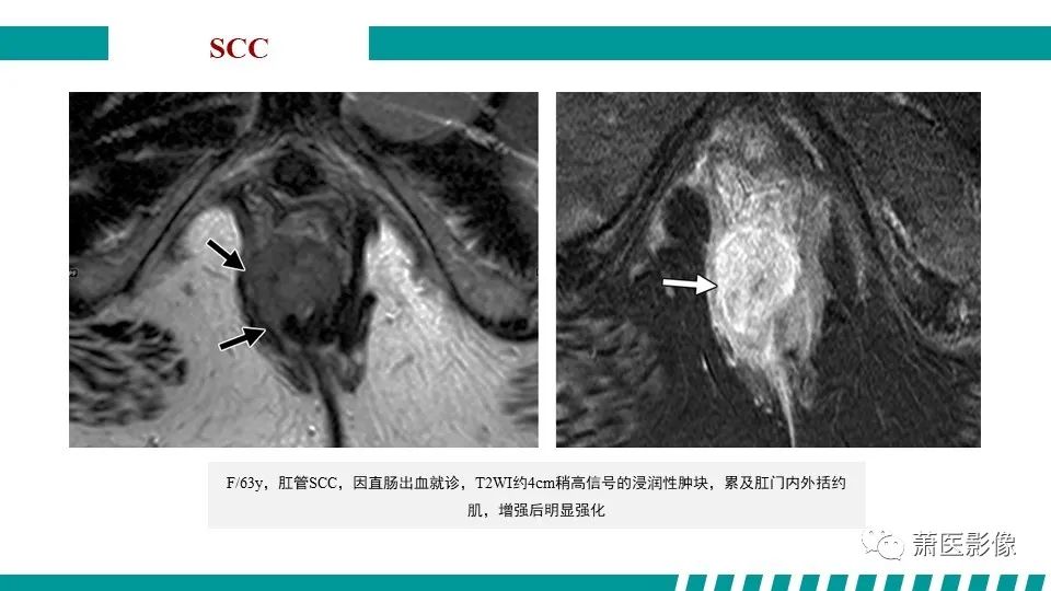 【PPT】肛管及肛周区域病变MRI影像特征-36
