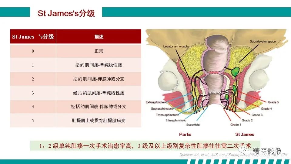 【PPT】肛管及肛周区域病变MRI影像特征-24