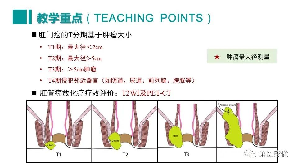 【PPT】肛管及肛周区域病变MRI影像特征-54