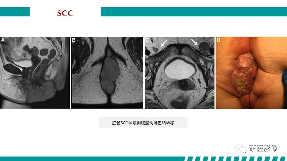 【PPT】肛管及肛周区域病变MRI影像特征-38