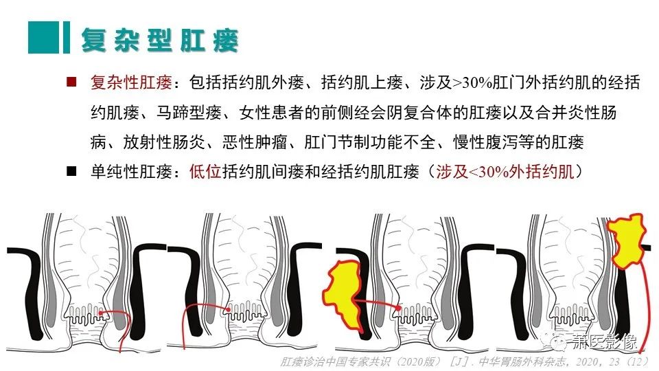【PPT】肛管及肛周区域病变MRI影像特征-20