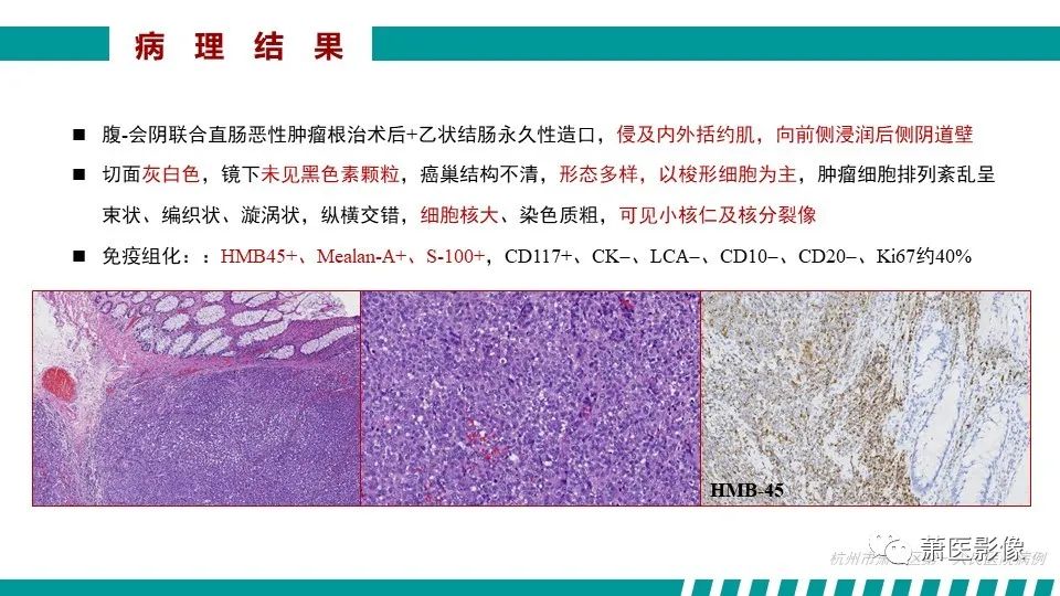 【PPT】肛管及肛周区域病变MRI影像特征-49