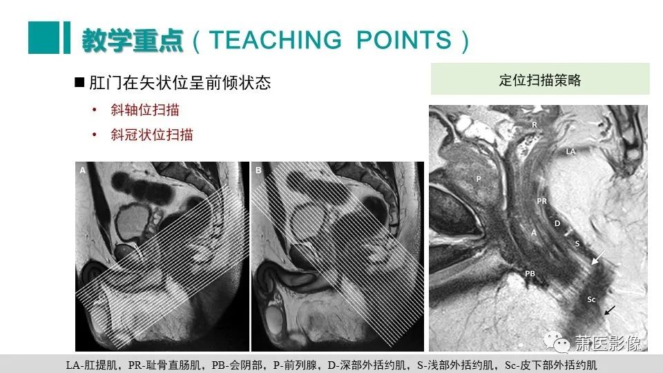 【PPT】肛管及肛周区域病变MRI影像特征-52