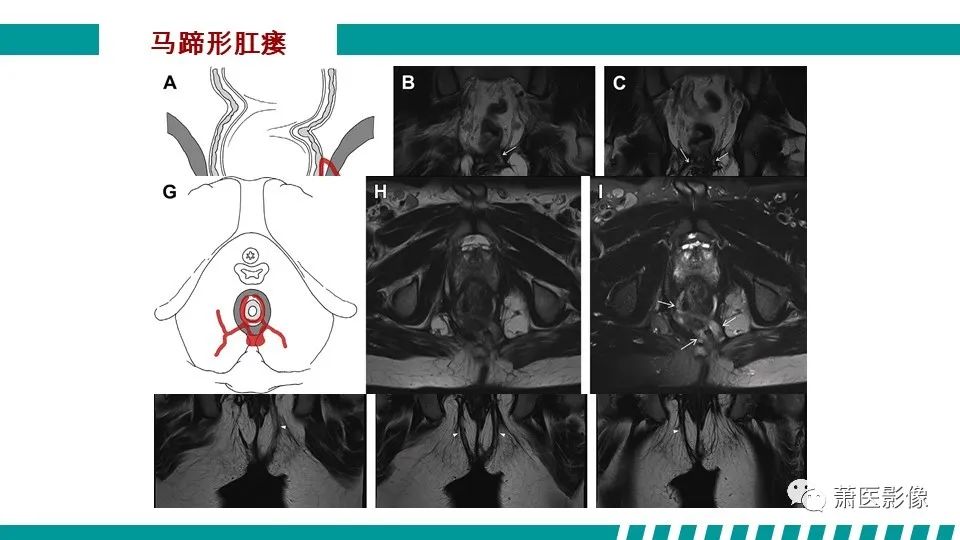 【PPT】肛管及肛周区域病变MRI影像特征-30