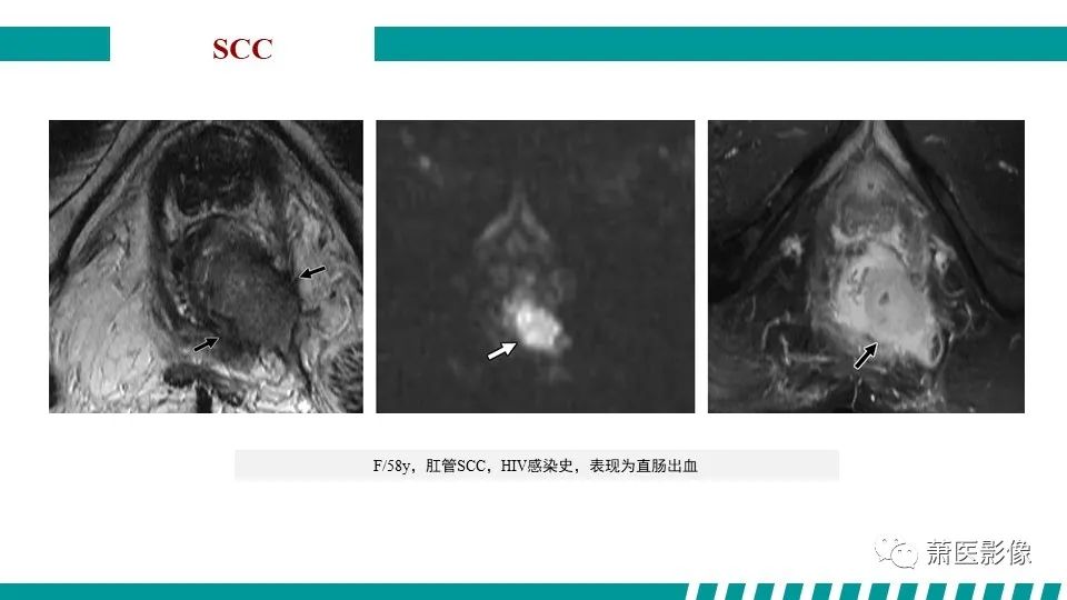 【PPT】肛管及肛周区域病变MRI影像特征-37
