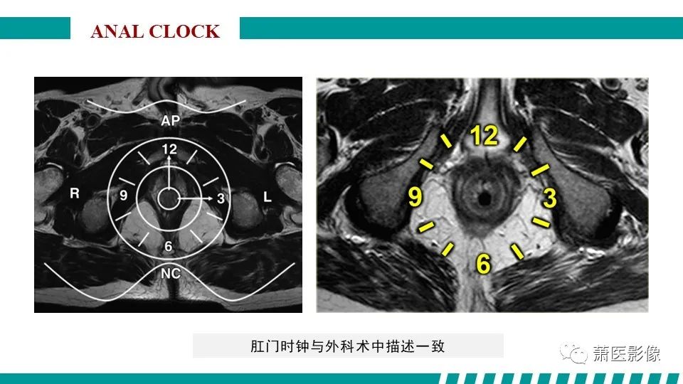 【PPT】肛管及肛周区域病变MRI影像特征-22