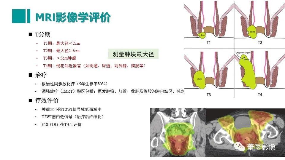 【PPT】肛管及肛周区域病变MRI影像特征-39