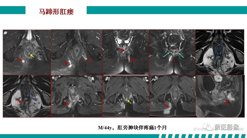 【PPT】肛管及肛周区域病变MRI影像特征-31
