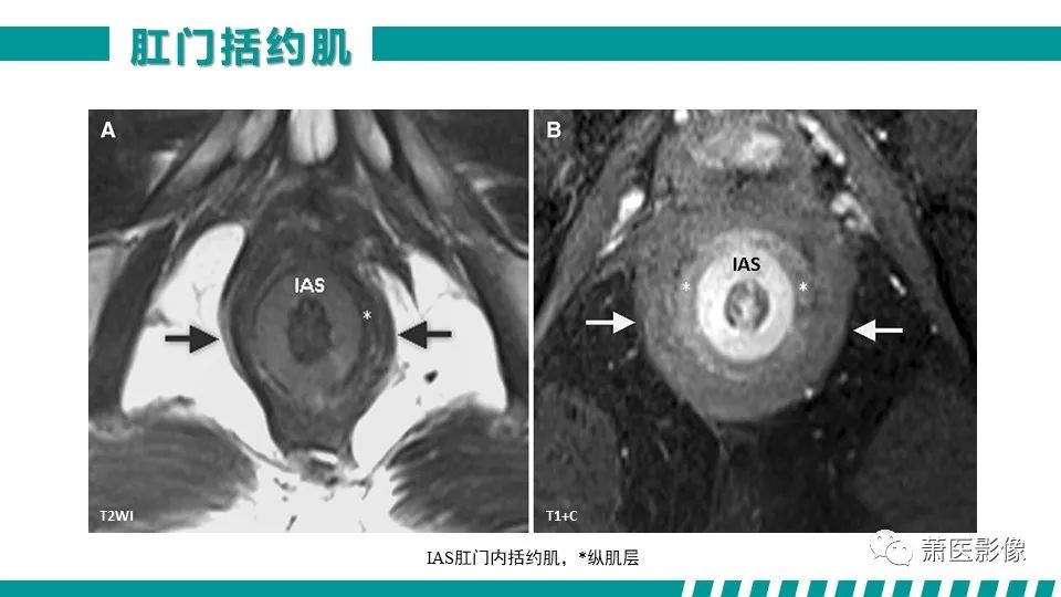 【PPT】肛管及肛周区域病变MRI影像特征-13