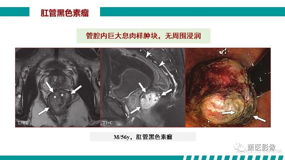 【PPT】肛管及肛周区域病变MRI影像特征-46