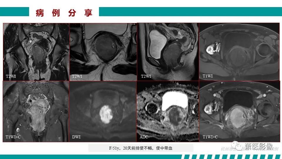 【PPT】肛管及肛周区域病变MRI影像特征-48