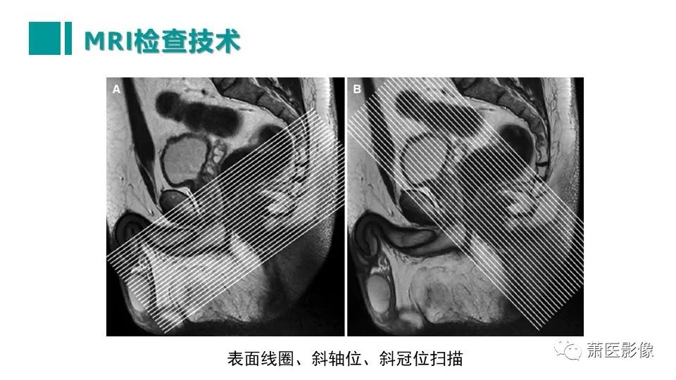 【PPT】肛管及肛周区域病变MRI影像特征-15