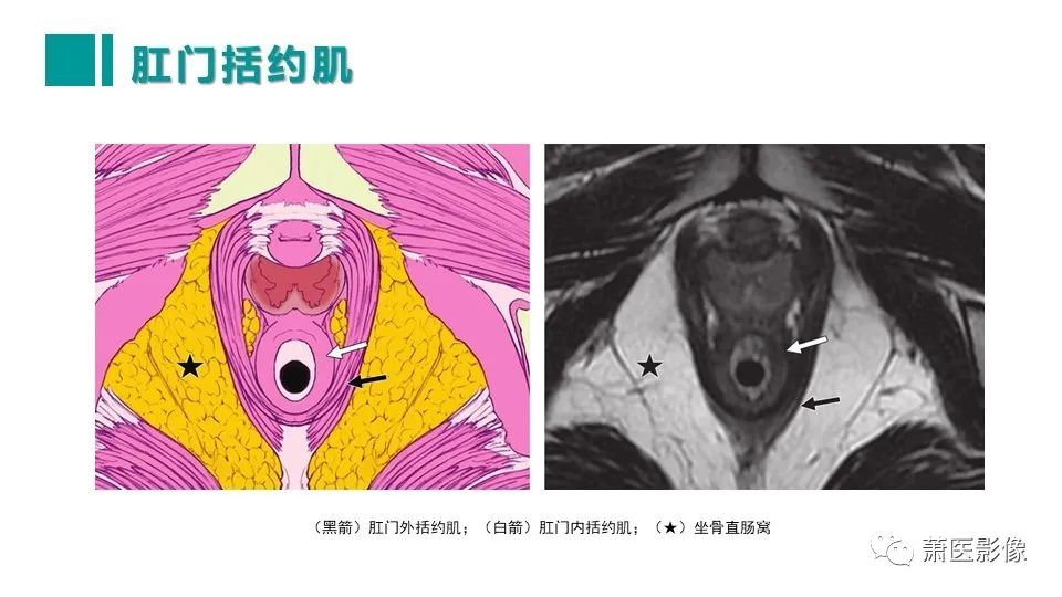 【PPT】肛管及肛周区域病变MRI影像特征-16