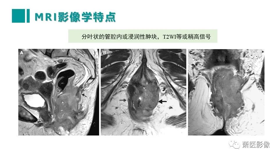【PPT】肛管及肛周区域病变MRI影像特征-35
