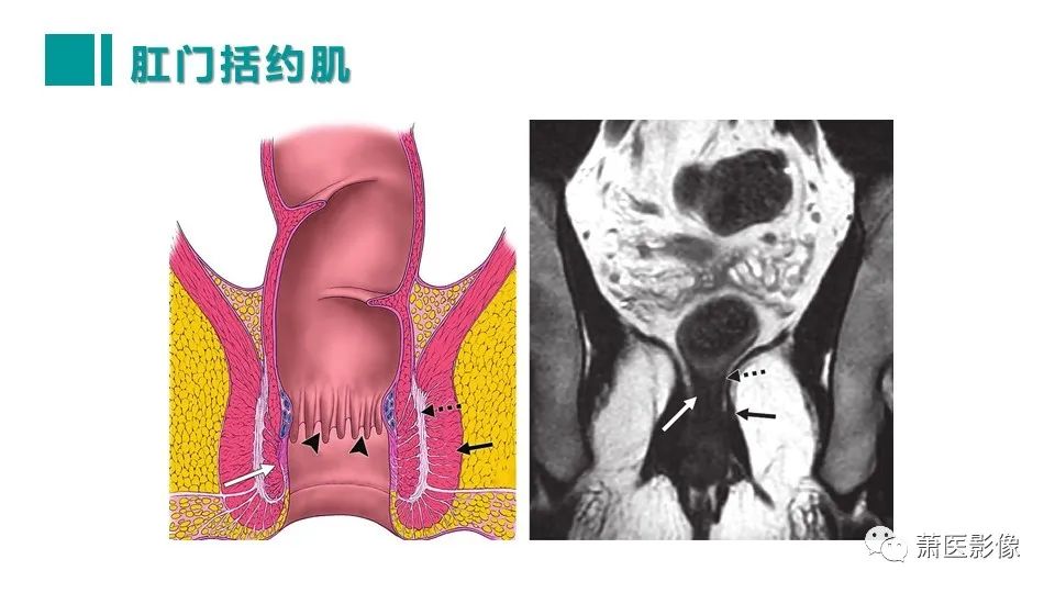 【PPT】肛管及肛周区域病变MRI影像特征-17