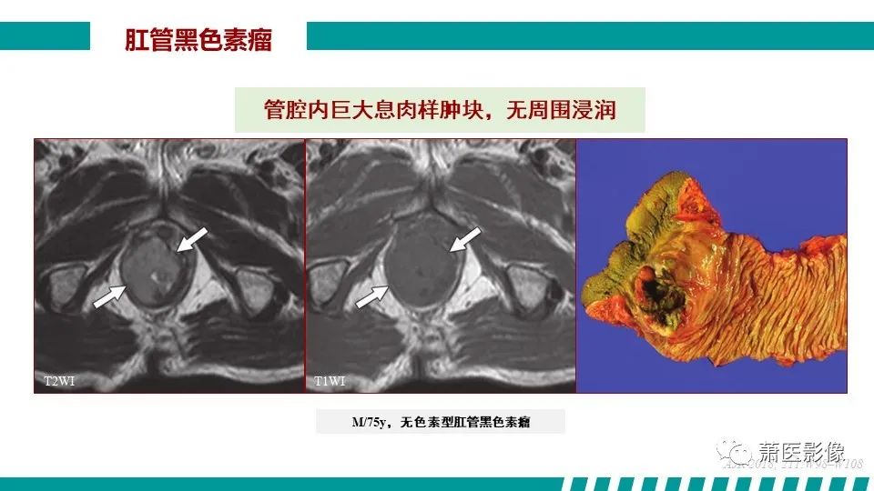 【PPT】肛管及肛周区域病变MRI影像特征-47