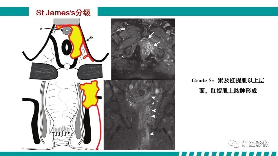 【PPT】肛管及肛周区域病变MRI影像特征-29