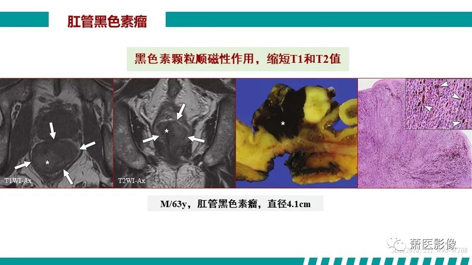 【PPT】肛管及肛周区域病变MRI影像特征-44