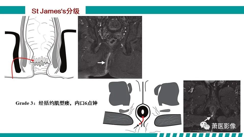 【PPT】肛管及肛周区域病变MRI影像特征-27