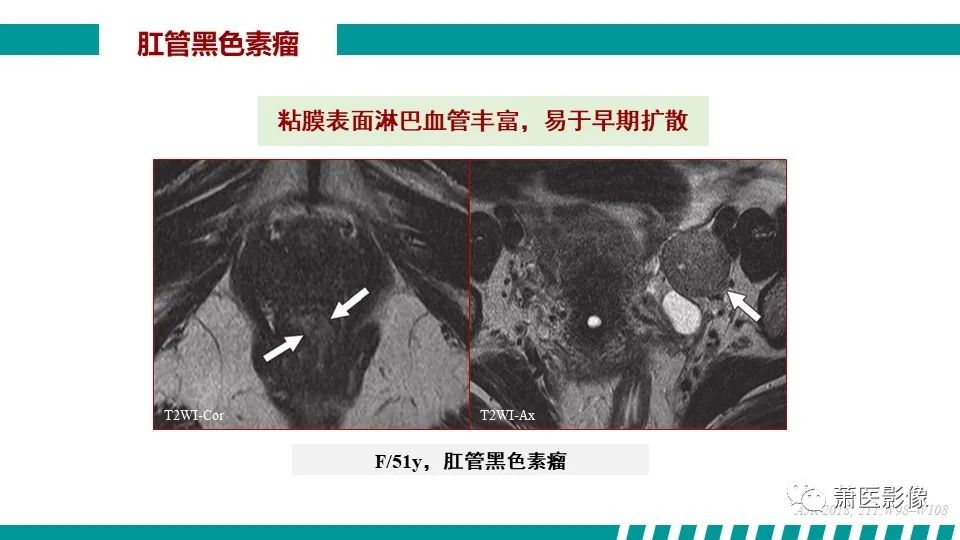 【PPT】肛管及肛周区域病变MRI影像特征-45