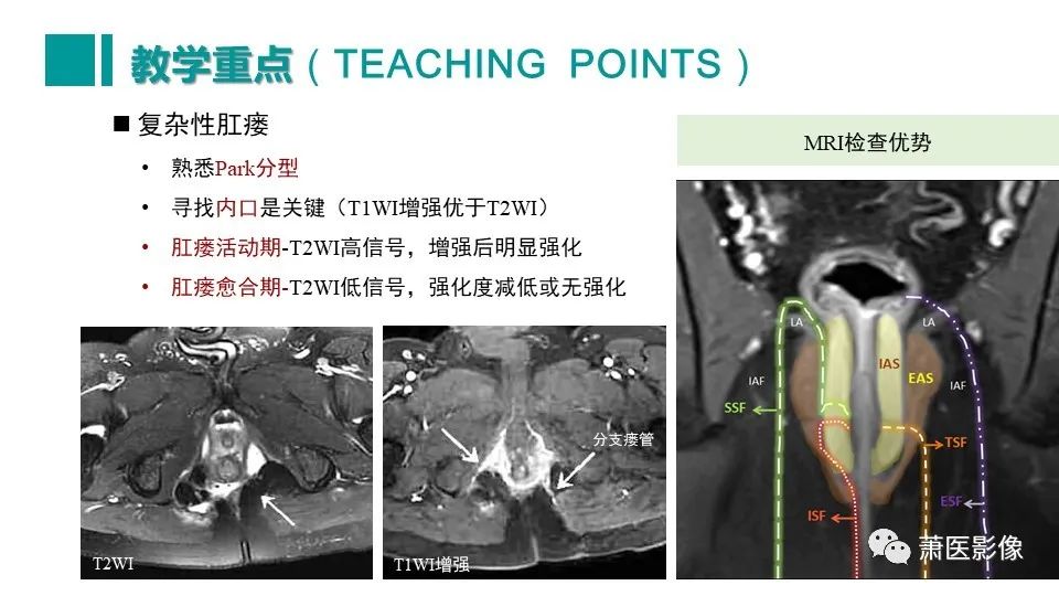 【PPT】肛管及肛周区域病变MRI影像特征-53