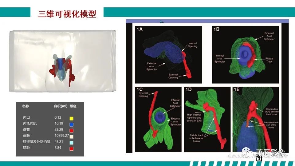 【PPT】肛管及肛周区域病变MRI影像特征-32