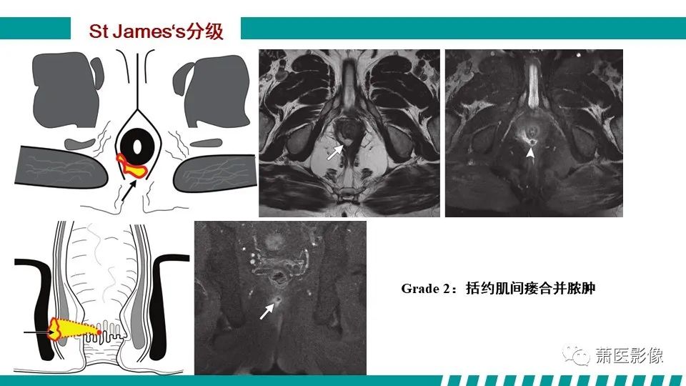 【PPT】肛管及肛周区域病变MRI影像特征-26