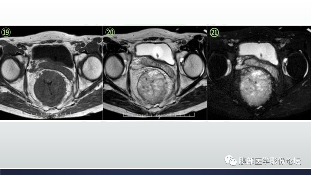 【病例】直肠血管瘤1例CT及MR-8