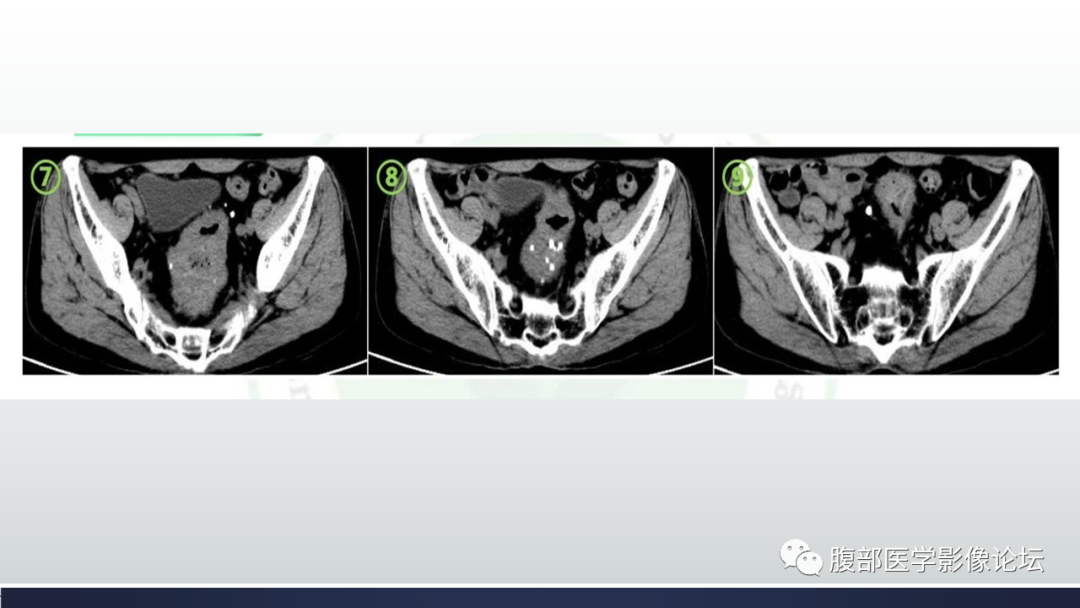 【病例】直肠血管瘤1例CT及MR-4
